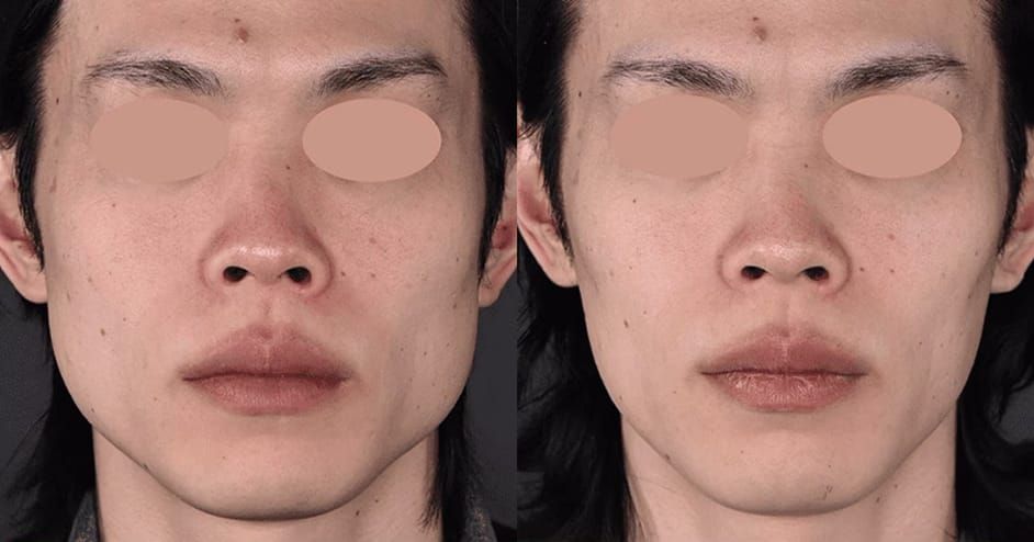 エラボトックス施術前後の症例写真