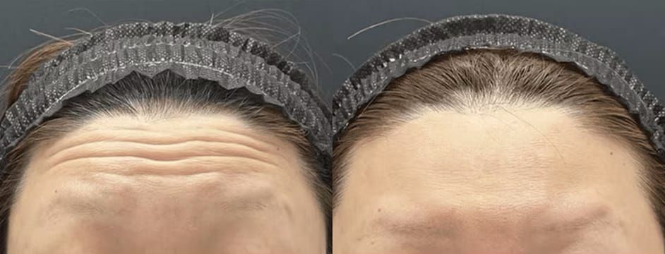 額ボトックス施術前後の症例写真