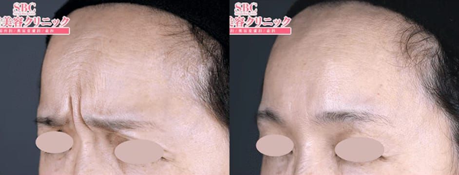 額ボトックス施術前後の症例写真