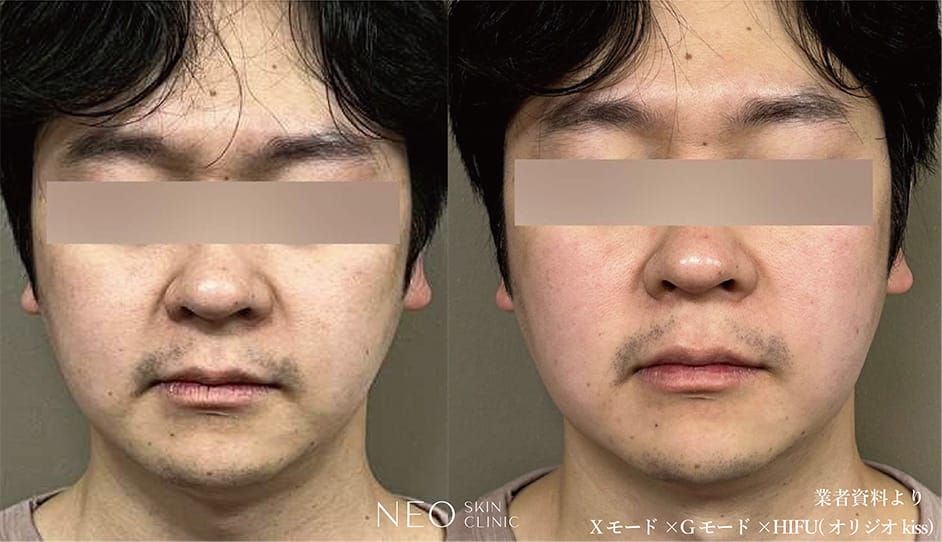施術前後の症例写真