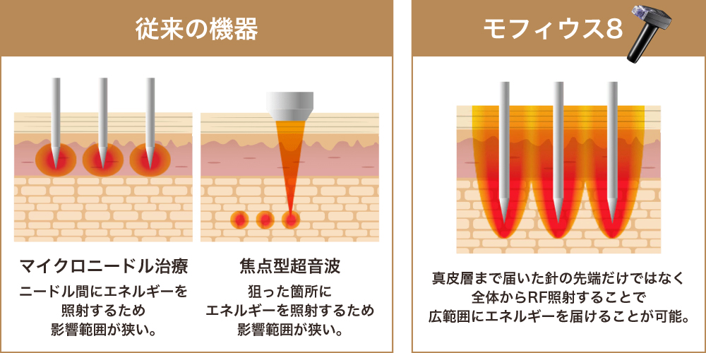 モフィウス8と従来の機器の違いの図解