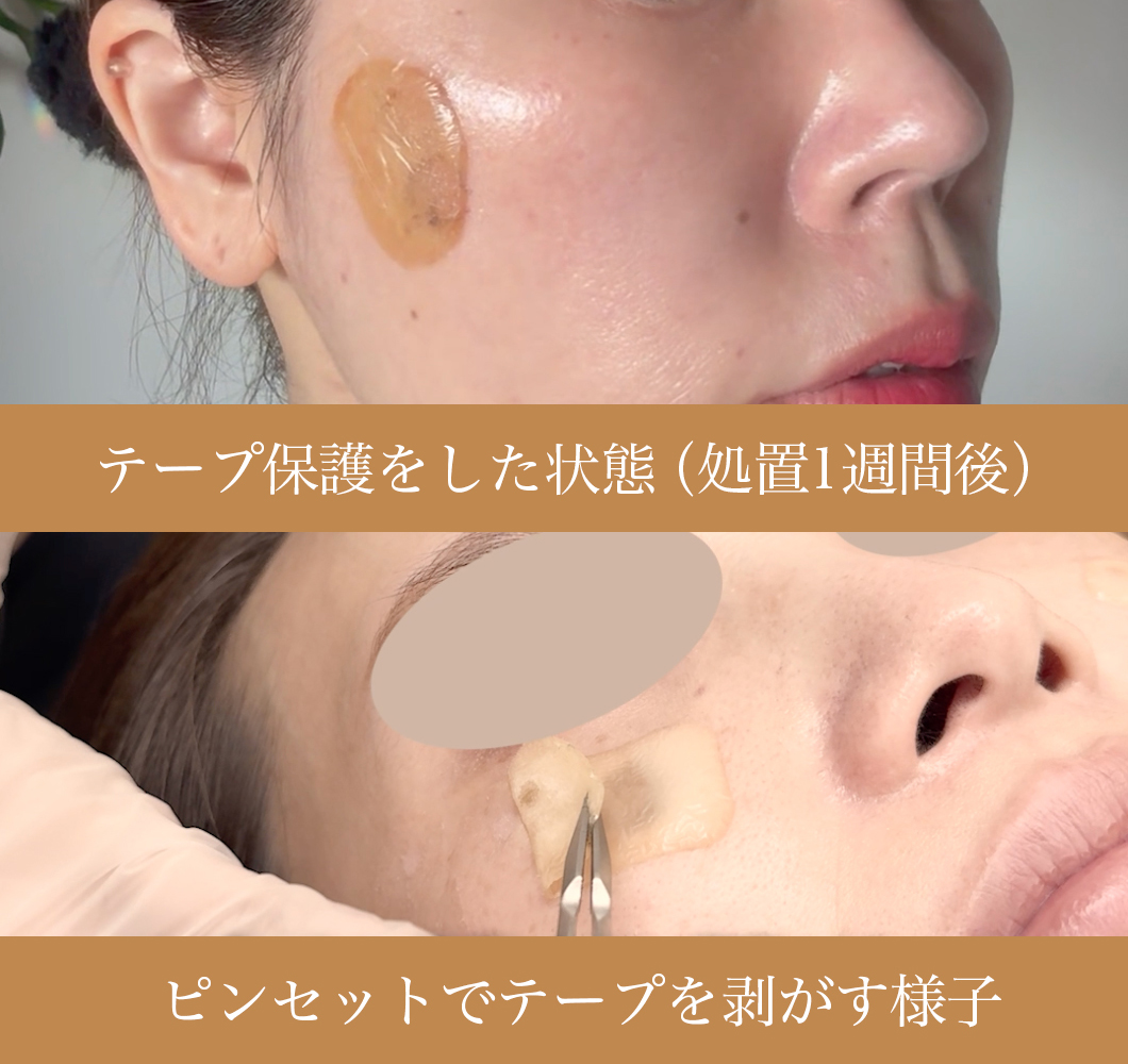 NEOスキンクリニック_リポットレーザーのテープ保護