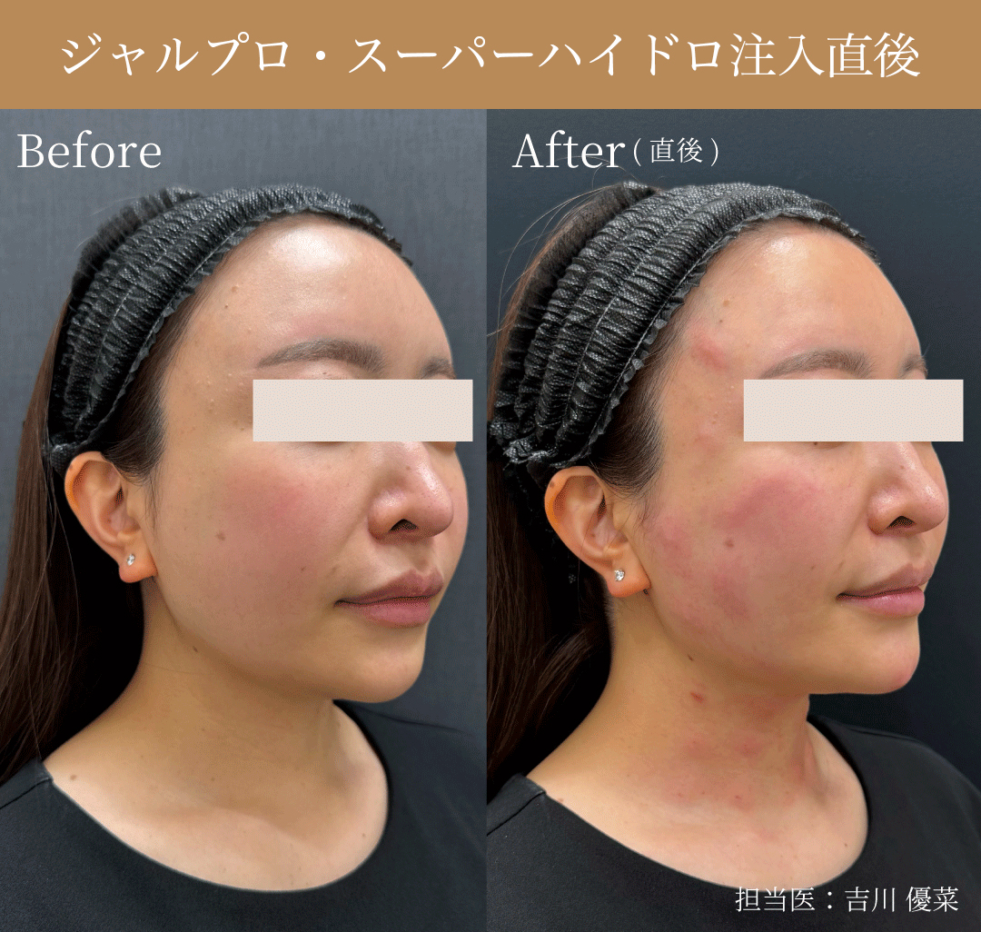ネオスキンクリニック_ジャルプロ_注入直後.jpg