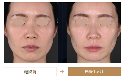 ジャルプロスーパーハイドロの症例写真