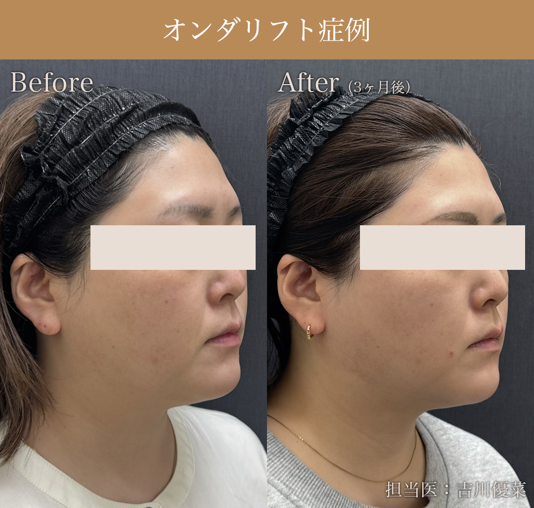 オンダリフトの症例写真_2
