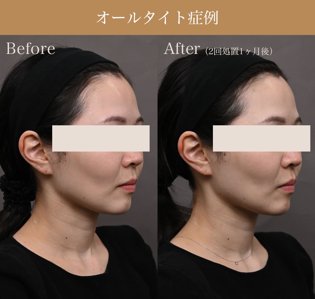 オールタイトの症例写真