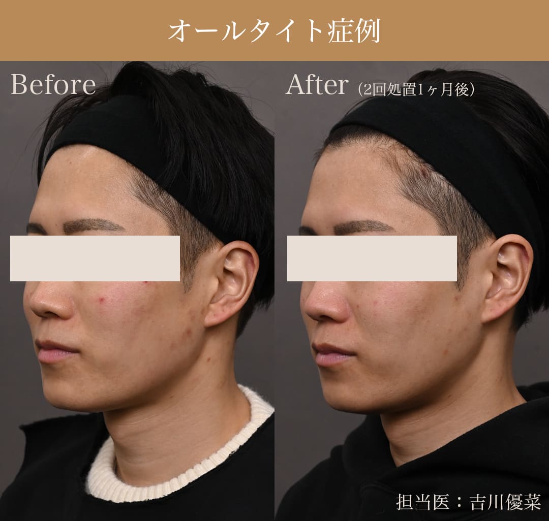 オールタイトの症例写真