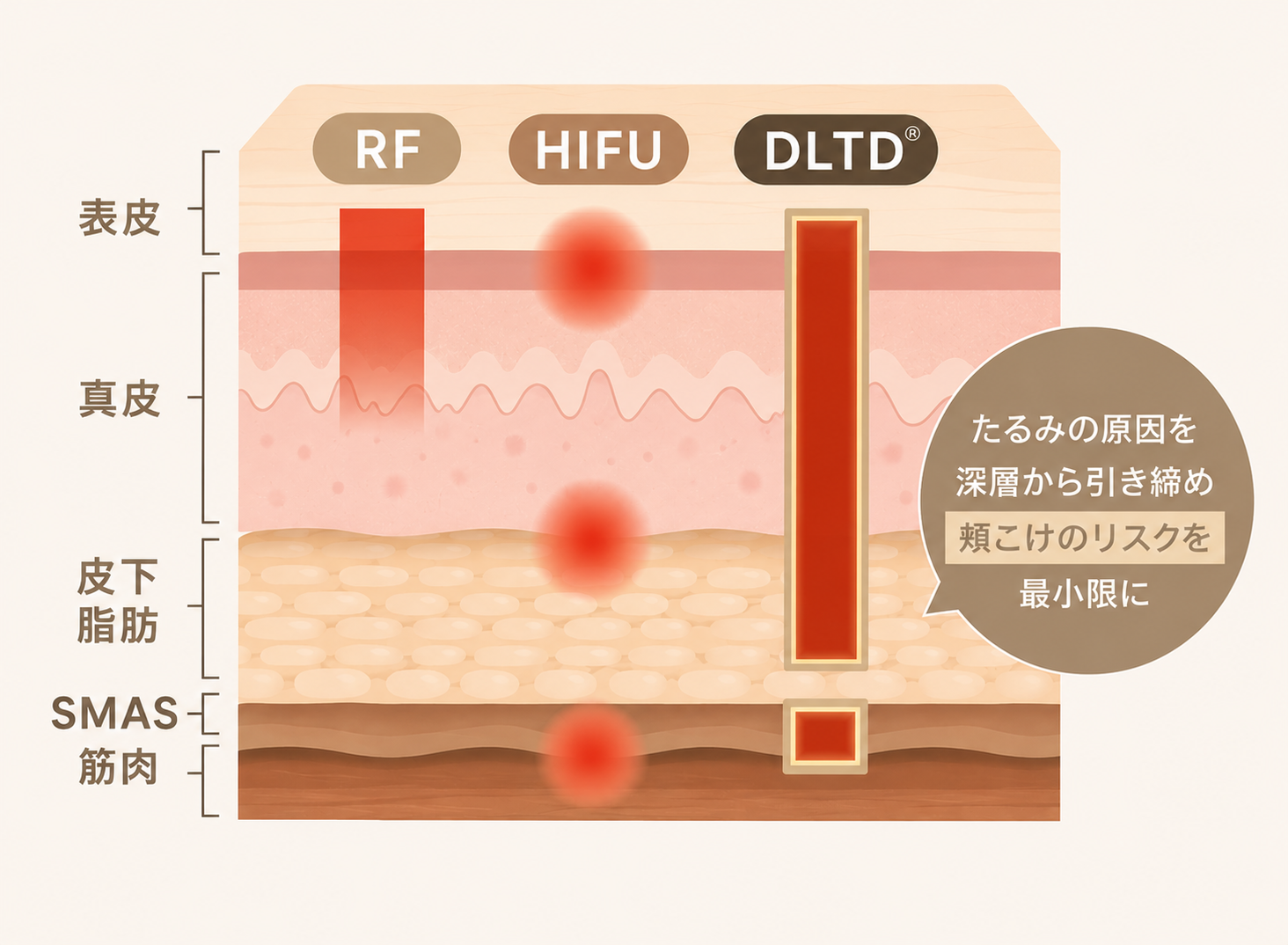 特許技術「フォーカスポーラ（DLTD®）」のイメージ画像