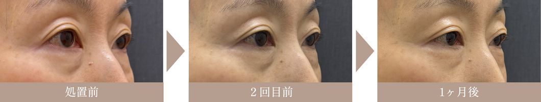 NeoSkinClini_モフィウス8の症例写真2