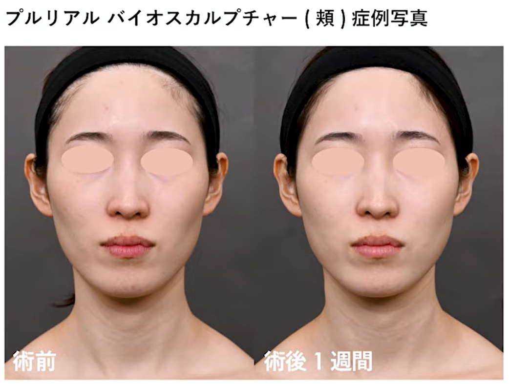 プルリアル バイオスカルプチャーの症例写真