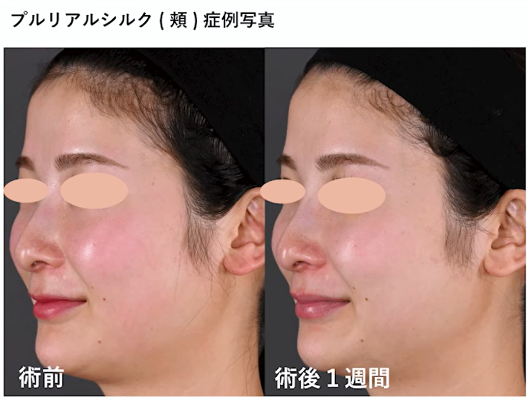 プルリアル シルクの症例画像
