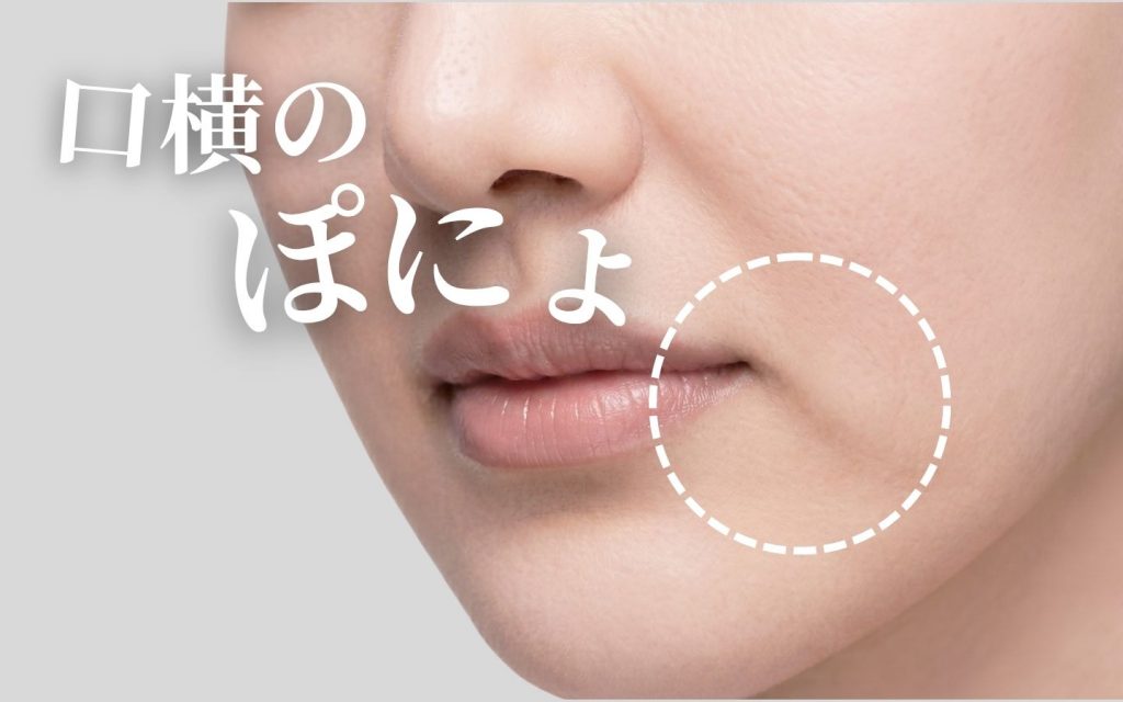 口横のぽにょについての画像