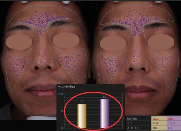 モフィウス8VISIA症例画像
毛穴の数値