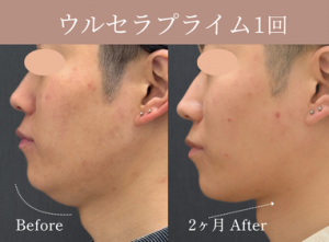 ウルセラプライムの症例のサムネイル画像