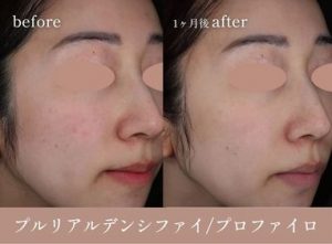 プルリアルデンシファイとプロファイロの症例解説コラムの画像