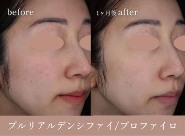 プルリアルデンシファイとプロファイロの症例解説コラムの画像