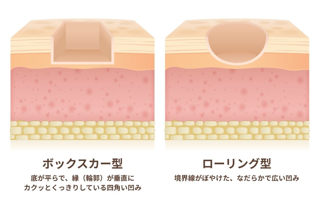 トライフィルプロの毛穴タイプ