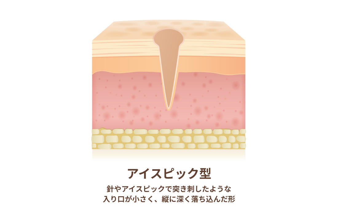 キュアジェットの毛穴タイプ